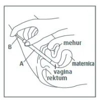 canesten3 krema