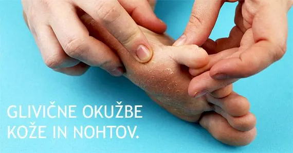 Glivične okužbe kože in nohtov.