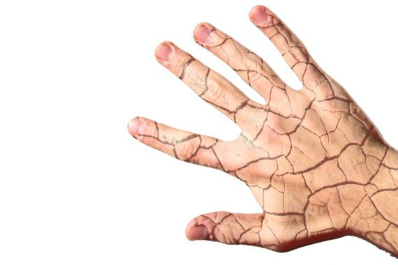 Atopijski dermatitis