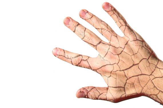 Atopijski dermatitis: Uzroci, simptomi i liječenje